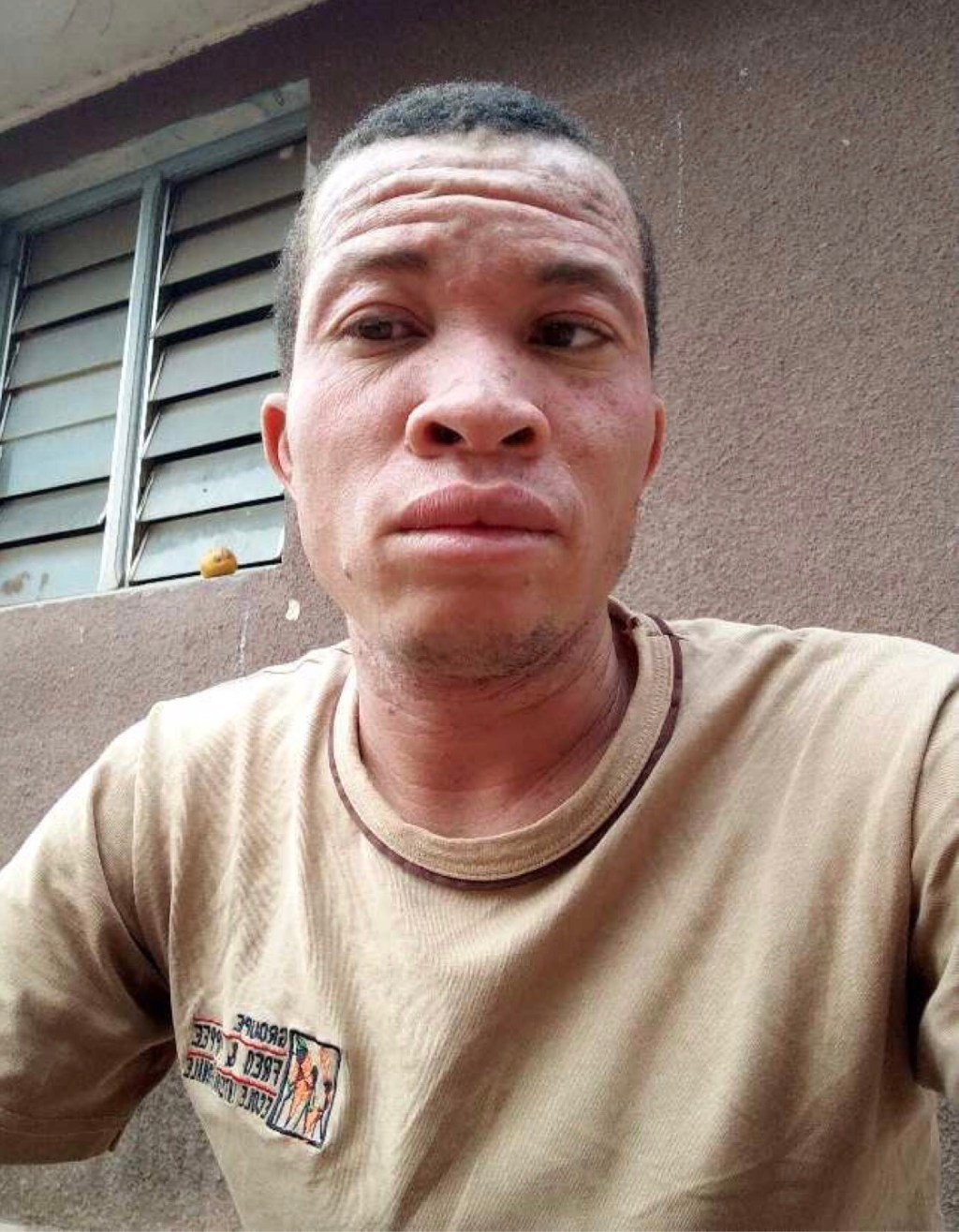 &laquo;&nbsp;Mohamed&nbsp;&raquo; assailli par les griffes de la stigmatisation en raison de son&nbsp;albinisme&nbsp;