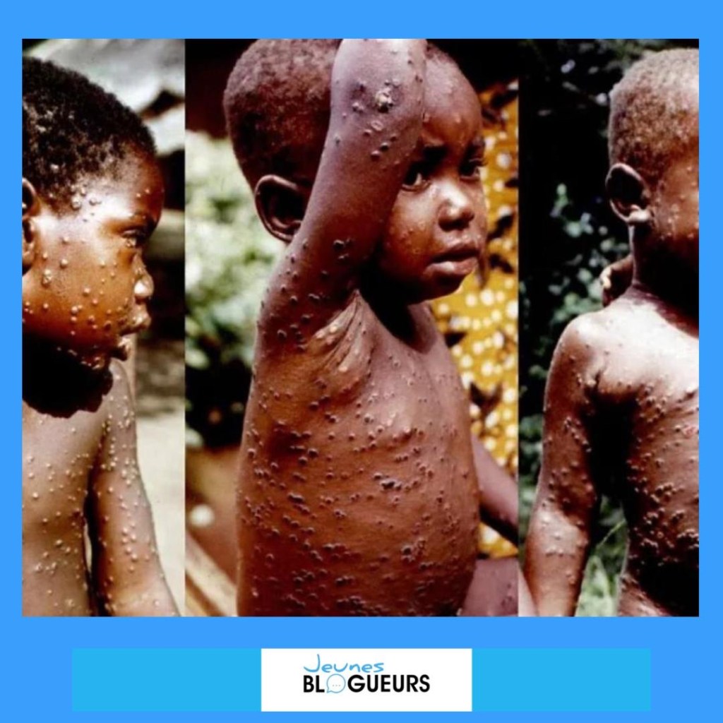 Variole du Singe en Côte d’Ivoire/ Protégeons Nos Enfants Face à une Crise Sanitaire&nbsp;Persistante